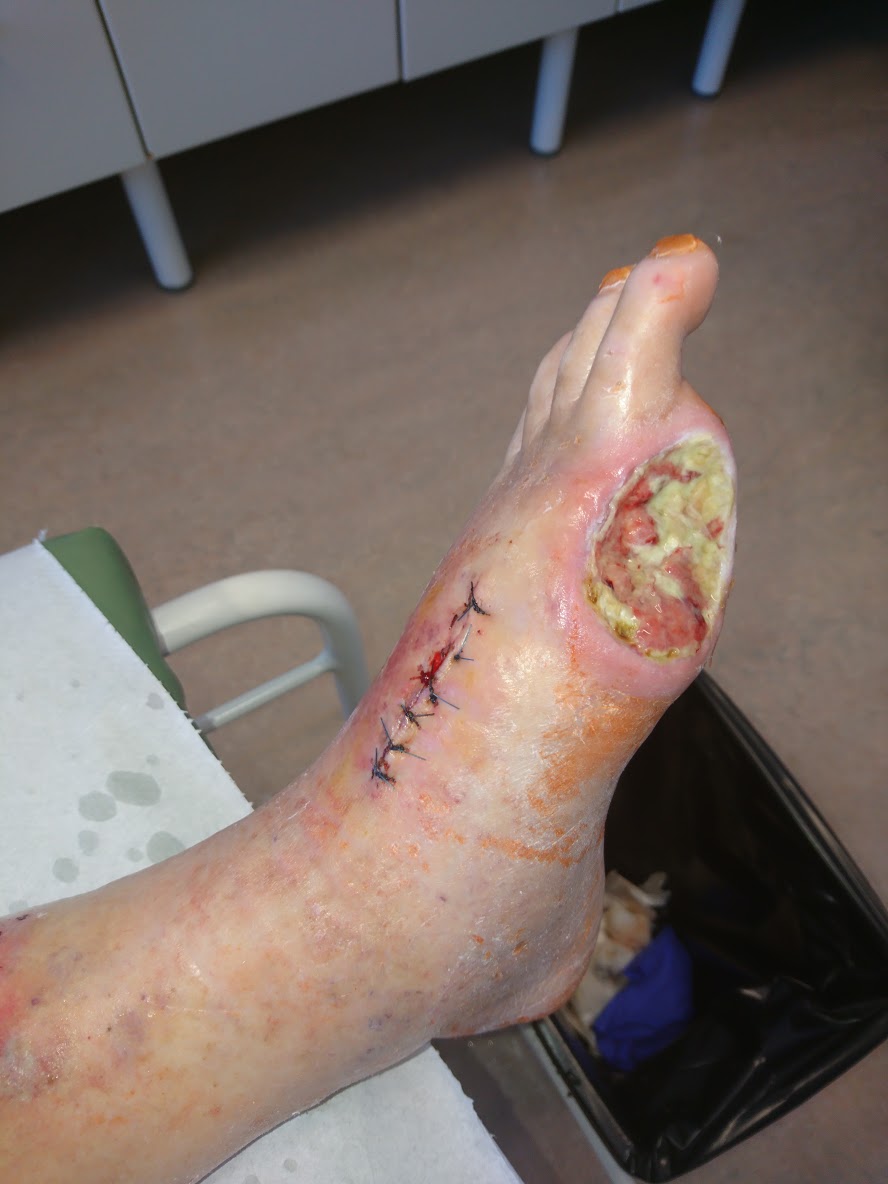 Rana po amputaciji palca, potem ko je bila pri bolniku narejena obvodna operacija, rana se lepo celi
